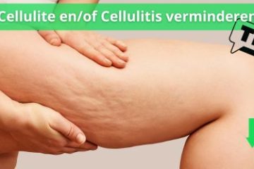 cellulitis minderen tips
