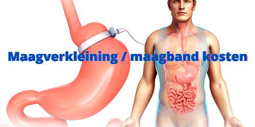 Maagverkleining maagband kosten