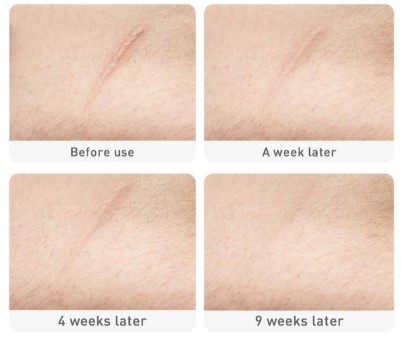 Littekencreme resultaten