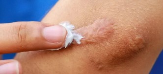 Littekenzalf herstel