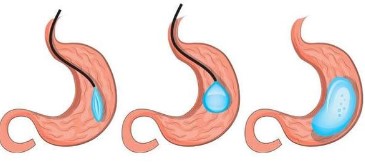 Maagballon ingreep afvallen