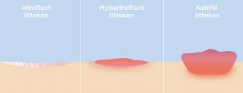 Soorten littekens